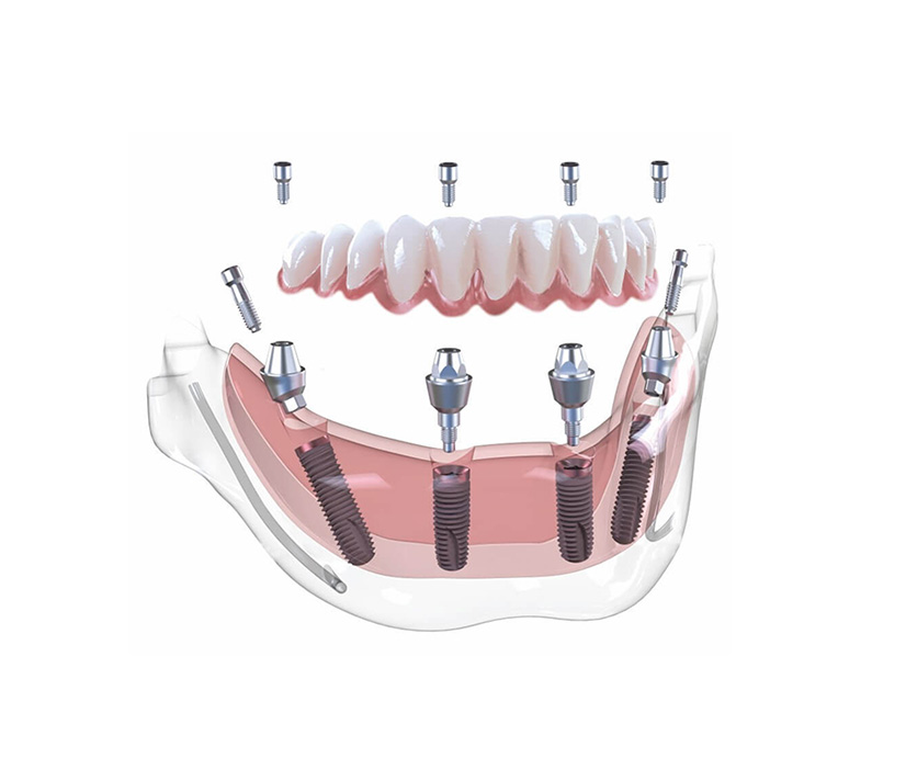 Migliore Dentista In Croazia H Dent